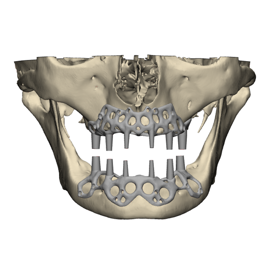 Specially designed for the anatomical structure of the bone under the periosteum, subperiosteal implants are produced from medical grade Ti-6Al-4V material. By using the design freedom provided by additive manufacturing, material removal is performed by mesh method in the desired region or material density is provided in areas where strength is required such as abutment locations.